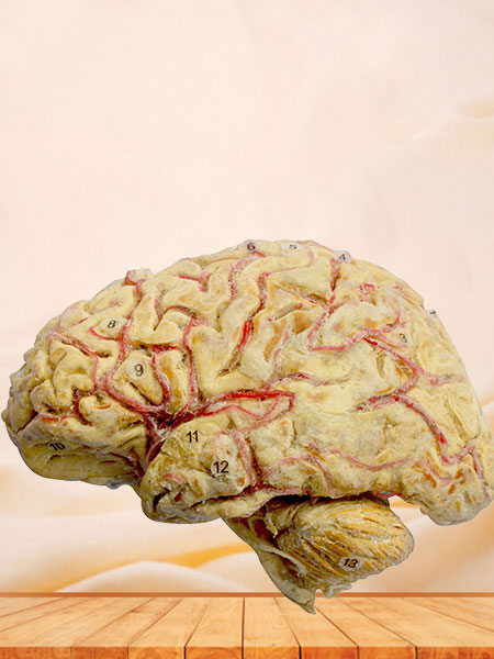 Cerebral hemisphere and brain stem plastination