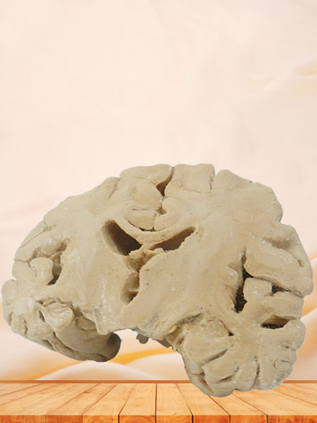 Coronal section of brain