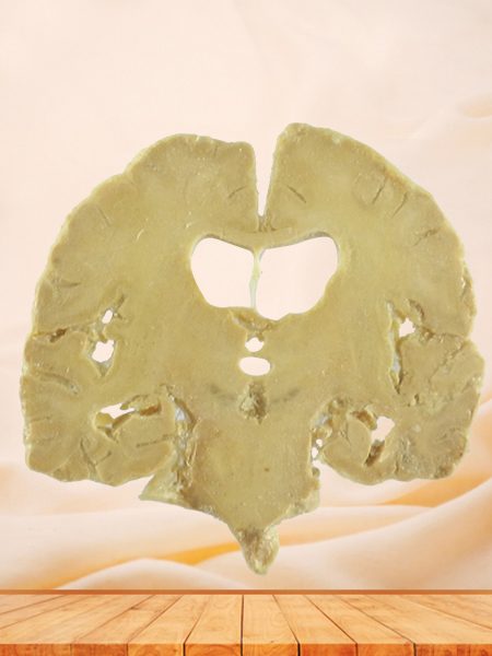 coronal section of human brain