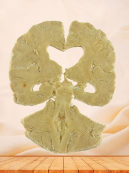 Coronal section of human brain plastination with 5 parts