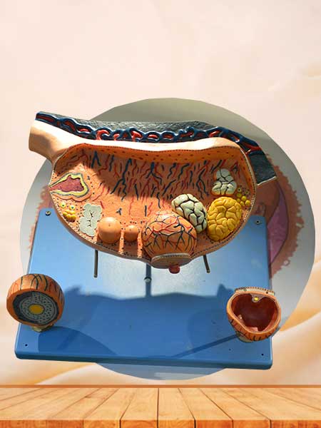 Enlarged ovary model