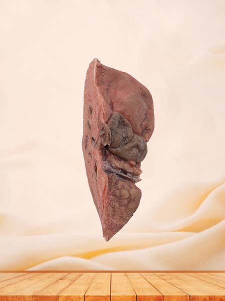 Pathlogy Liver Anatomy Model