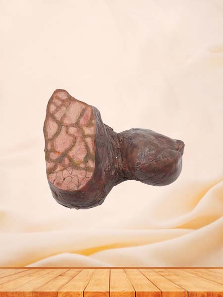 Pathological Liver Anatomical Model