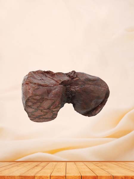 Pathological Liver Anatomical Model