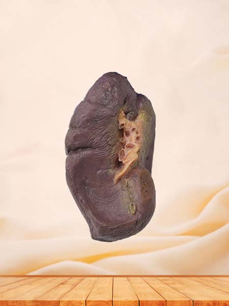 Soft Simulated Pathological Spleen Model